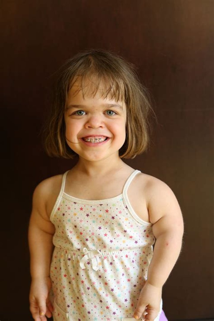 Achondroplasia Positive Exposure