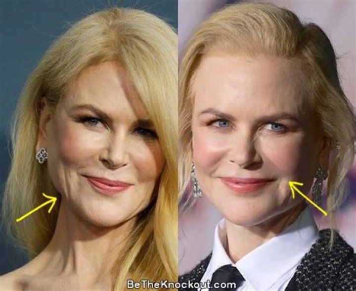 Did Nicole Kidman Have Plastic Surgery? See Transformation