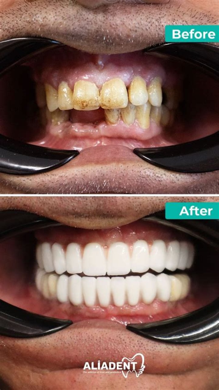Discover The Transformation Of "Maneet Before And After"