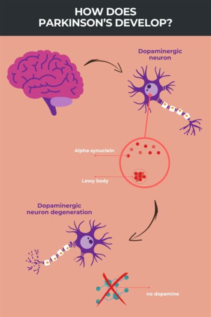 Does Parkinson's Cause Fatigue