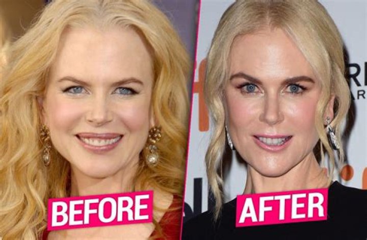 Nicole Kidman Plastic Surgery Photos [Before & After] ⋆ Surgery4