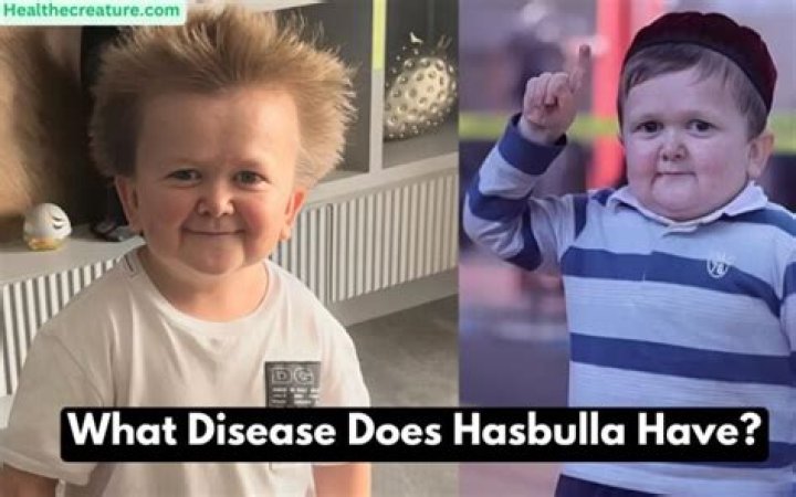 Unlocking The Secrets Of Hasbulla Disease: Discoveries And Insights