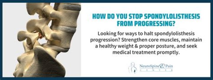 Unlocking The Secrets Of Spondylolisthesis