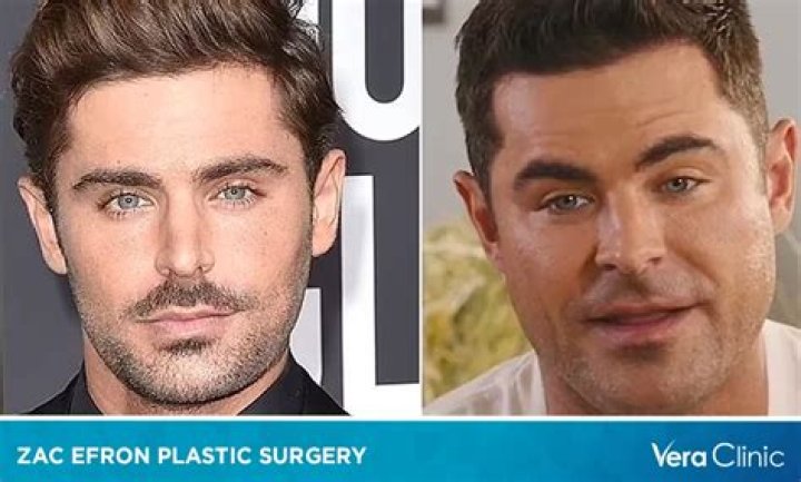 Unraveling Zac Braff's Plastic Surgery: A Journey Of Discovery