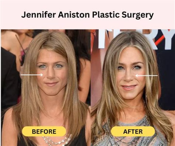 Unveiling Jennifer Aniston's Plastic Surgery Secrets: Discoveries And Insights