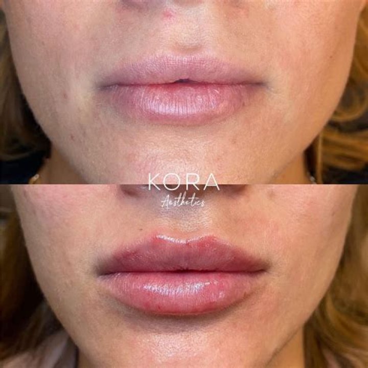 What Are Lip Fillers? Information from VIVO Clinic